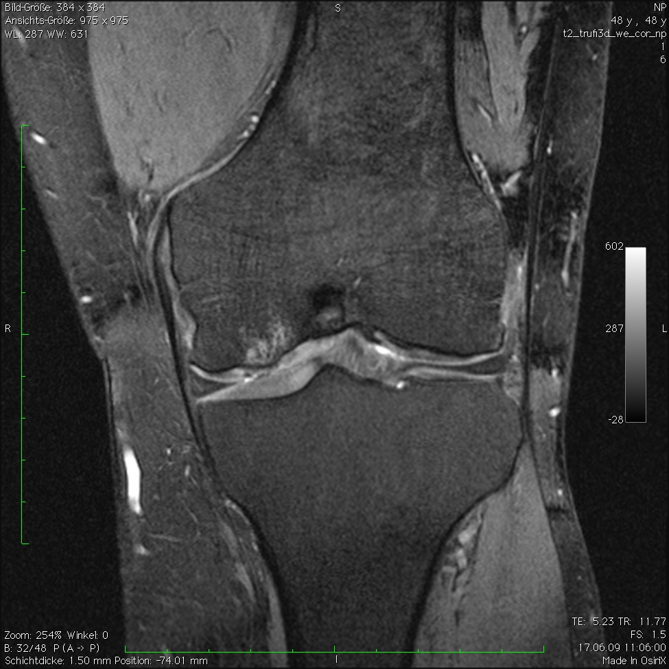 MRI of knee with arthritis after the stem cell research and therapy
